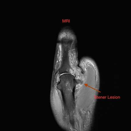 mri of a stener lesion in a thumb