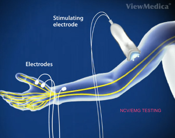 stimulating electrode being used on an arm