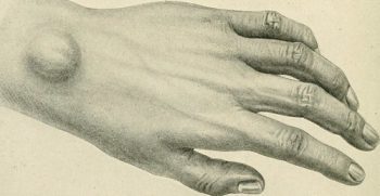 Pencil sketch of left hand with small cyst on the wrist.