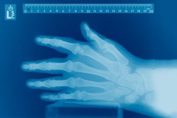 An X-ray of someone's left hand with a ruler at the top all in blue shades.