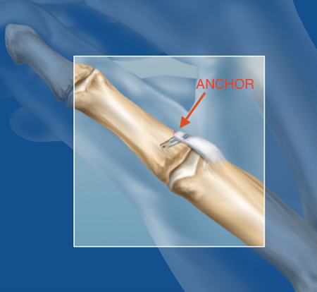 anchor placed in a thumb to treat gamekeeper's thumb