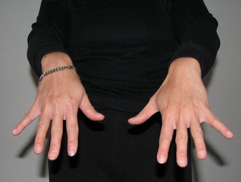 trigger finger exercises