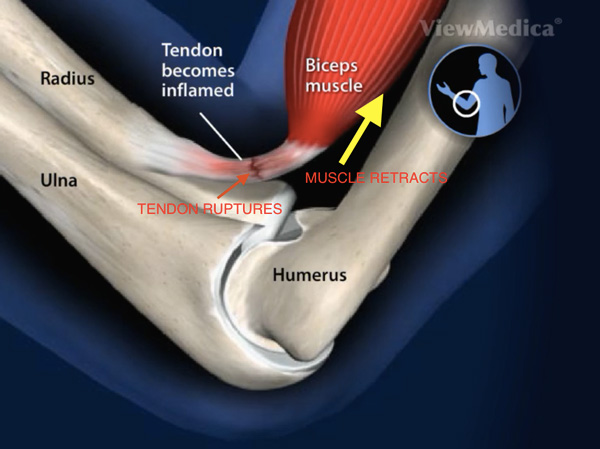 thumb ligament pulling away from a portion of bone