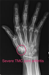 x-ray of hand with severe basal thumb arthritis
