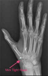 x-ray of hand after basal thumb arthritis surgery