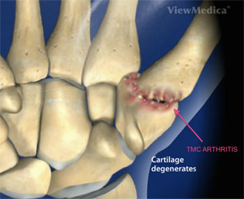 basal thumb arthritis treatment in dallas, tx