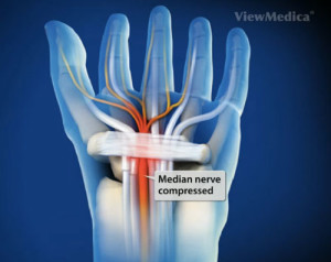 carpal tunnel treatment in dallas, tx
