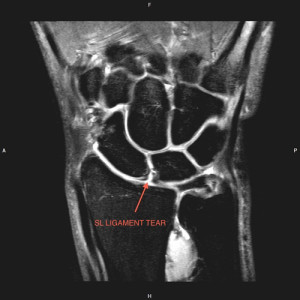 xray showing ligament tear