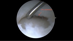 picture of arthroscopic surgery to repair triangular fibrocartilage tear