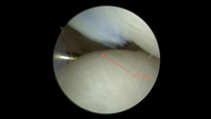 picture of arthroscopic surgery to repair triangular fibrocartilage tear