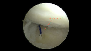 picture of arthroscopic surgery to repair triangular fibrocartilage tear