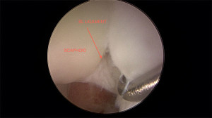 picture from arthroscopic surgery of ligament tear