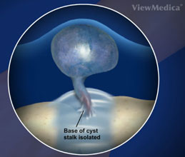 illustration of internal view of ganglion cyst
