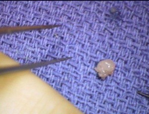 Glomus Tumor