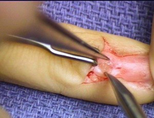 Glomus Tumor Finger