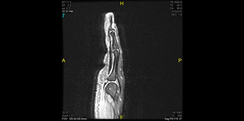 Glomus Tumor Xray
