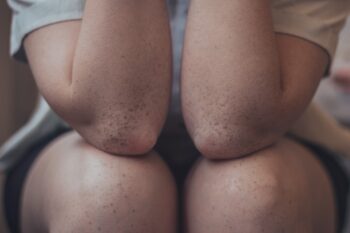 Person sitting with their elbows resting on their knees