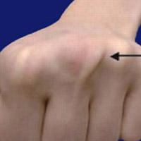 sagittal-band-tear-symptoms