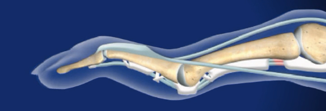 scaphoid fracture treatment in dallas, tx